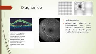 Coriorretinopatía Serosa central [upl. by Nednil]