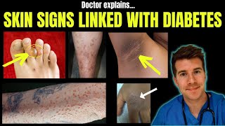 Doctor explains 12 SKIN CONDITIONS associated with DIABETES [upl. by Mcintosh]