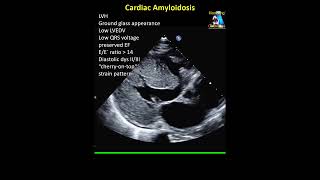 Cardiac Amyloidosis [upl. by Nnayrrehs422]