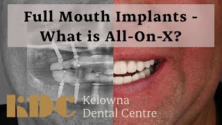 Full Mouth Implants  What is AllOnX [upl. by Eizeerb]