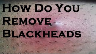 How to remove blackheads [upl. by Corell]