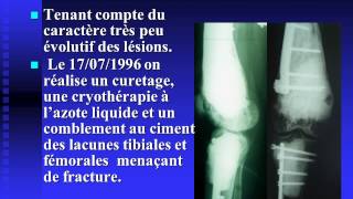 Hémangioendothéliome épithélioïde multifocal du membre inférieur [upl. by Melva764]