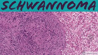 Schwannoma 5Minute Pathology Pearls [upl. by Soo477]