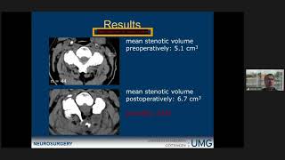 Unilateral hemilaminectomy for bilateral decompression in cervical spondylotic myelopathy [upl. by Dettmer]