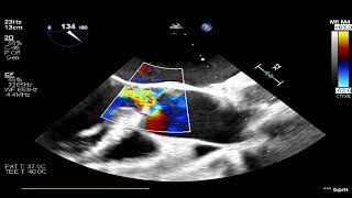 TEE AV endocarditis with leaflet perforation [upl. by Nylitak]