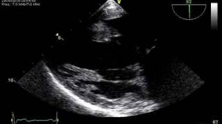 3 RUPTURE CHORDAE TRANSGASTRIC TOE VIEW MITRAL REGURGITATION [upl. by Trudie]