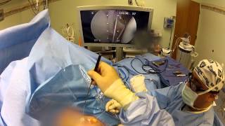 Arthroscopic Shoulder Bankart and SLAP Repair Surgery Filmed on GoPro Hero 2 [upl. by Lehcnom]