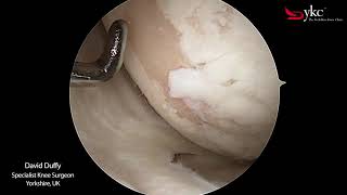 What Does Arthritis of The Knee Joint Look Like [upl. by Landre]