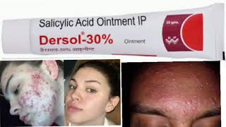 Dersol 30 Ointment Salicylic Acid Ointment IP [upl. by Erlina]