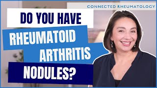 Surprise cause of Rheumatoid Arthritis nodules and everything else you need to know [upl. by Vanhook]