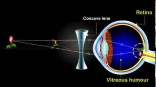 what is myopia Short Sightedness [upl. by Dasha]