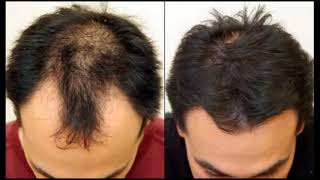 Results of using Minoxidil 5 before and after [upl. by Steffy484]