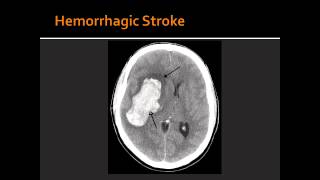 Atherosclerosis Hemorrhagic Stroke Ischemic Stroke amp Transient Ischemic Attack TIA [upl. by Nosle]