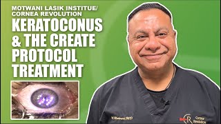 Keratoconus Treatment to Restore Vision Cornea Repair Epithelium and Topography Enhancement [upl. by Beckett707]