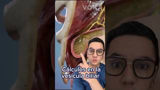 ¡Alerta Cálculos en la vesícula biliar colelitiasis medicina shorts [upl. by Nester]