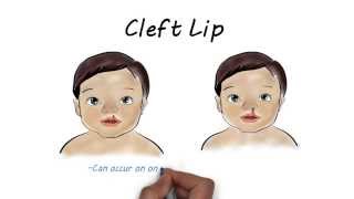 Cleft lip and Cleft Palate Surgery V1 [upl. by Elbring331]