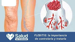 FLEBITIS “Requiere de un buen diagnóstico médico” [upl. by Sturges100]