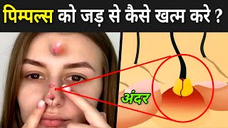 पिम्पल्स को जड़ से कैसे खत्म करे   How Pimples Are Formed In Hindi  Pimple Ka ilaj [upl. by Ninnetta]