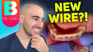 Braces Wire Tightening  Why amp How Your Orthodontist Changes Your Braces Wires [upl. by Ahsurej]