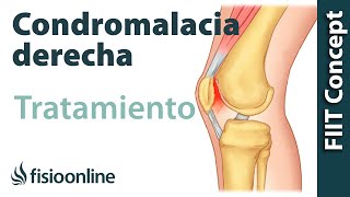 Tratamiento de la condromalacia rotuliana derecha [upl. by Droflim191]