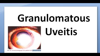 Ophthalmology 162 a Granulomatous uveitis chronic mutton fat keratic precipitates Tubercular VKH [upl. by Alida]