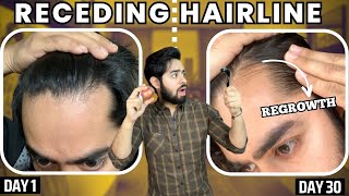 सिर्फ 1 महीने मैं RECEDING HAIRLINE REGROW करो  30 days HAIRLINE REGROWTH challenge [upl. by Grati]