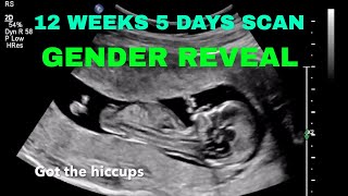 12 weeks 5 days Ultrasound GENDER REVEAL [upl. by Krissie899]