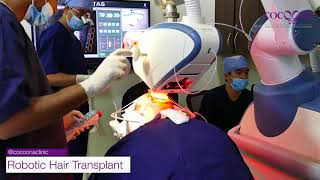 Robotic Hair Transplant  Cocoona Clinic Dubai [upl. by Edgell641]