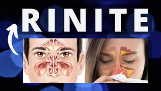 RINITE Definição classificação fisiopatologia caudas sintomas diagnósticocuidados enfermagem [upl. by Gareth]