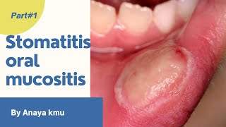 stomatitis in urdu  stomatitis in mouth in hindi  stomatitis nursing  stomatitis lecture in hindi [upl. by Gladis]