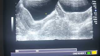 Normal female pelvic ultrasound [upl. by Charles]