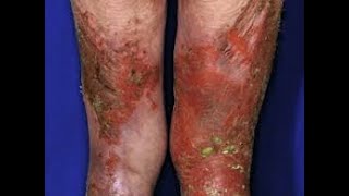 Erythema in Medicine 5 [upl. by Hsuk]