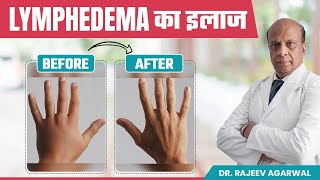 How to Manage Lymphedema Effective Treatment Options हिंदी में  Sentinel Lymph Node Biopsy [upl. by Riordan]