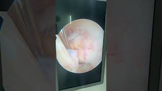 ACL ganglion cystkeyhole surgery arthroscopic decompression kneearthroscopy acl ganglioncyst [upl. by Alemaj439]