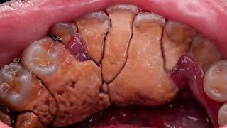 Tartar Removal by Dentist  removing tartar from teeth [upl. by Hanway]