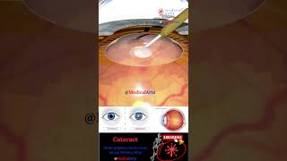 Cataract  Lens Implant  Medical Arts Shorts  3d animation surgery [upl. by Ueihtam750]