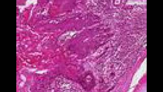 Histopathology Lung  Squamous cell carcinoma [upl. by Eilujna555]