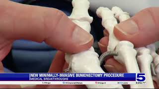 Medical Breakthrough New minimallyinvasive bunionectomy procedure [upl. by Johnsson]