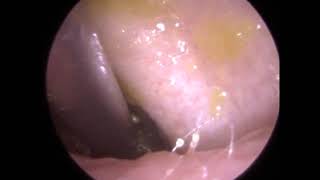 271  Ear Wax Removal using Jobson Horne Zoellner Sucker and Sodium Bicarbonate [upl. by Ettennig]