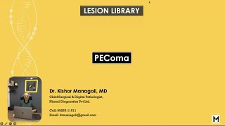 Pathology of PEComa [upl. by Nehemiah]