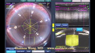 Lensx laser cataract surgery  brunescent cataract 101512 [upl. by Ariela]