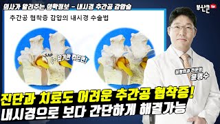 진단과 치료가 어려운 추간공협착증 척추내시경으로 간단하게 해결가능합니다부산큰병원 윤명수 병원장 [upl. by Ynnavoig]