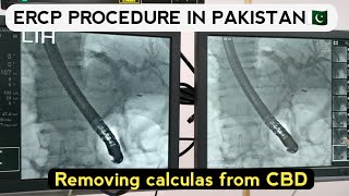 ercp stent procedure video  ercp test video in hindi Ercp in pakistan [upl. by Lombardi]