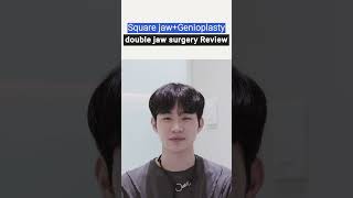 1 Year PostOp Review of Double Jaw Surgery for Male Lantern Jaw and Facial Asymmetry [upl. by Adnema]