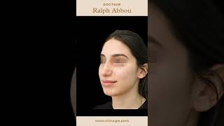 Résultat après rhinoplastie ultrasonique par Dr Abbou [upl. by Llertnov]