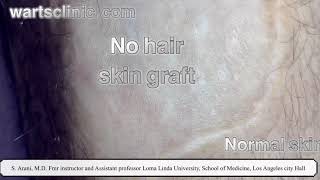 Skin graft and genital warts  not natural look [upl. by Aierdna]