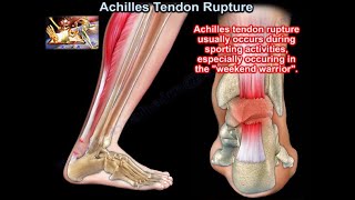 Achilles Tendon Rupture  Everything You Need To Know  Dr Nabil Ebraheim [upl. by Medora]