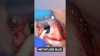 Apicoectomy Procedure Premolar  Endodontist Microsurgery under Microscope [upl. by Carly399]