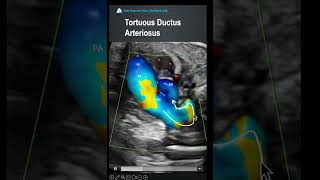 Tortuous Ductus arteriosus [upl. by Alrick358]