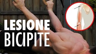 LESIONE DEL BICIPITE BRACHIALE CALISTHENICS [upl. by Ecitnerp]